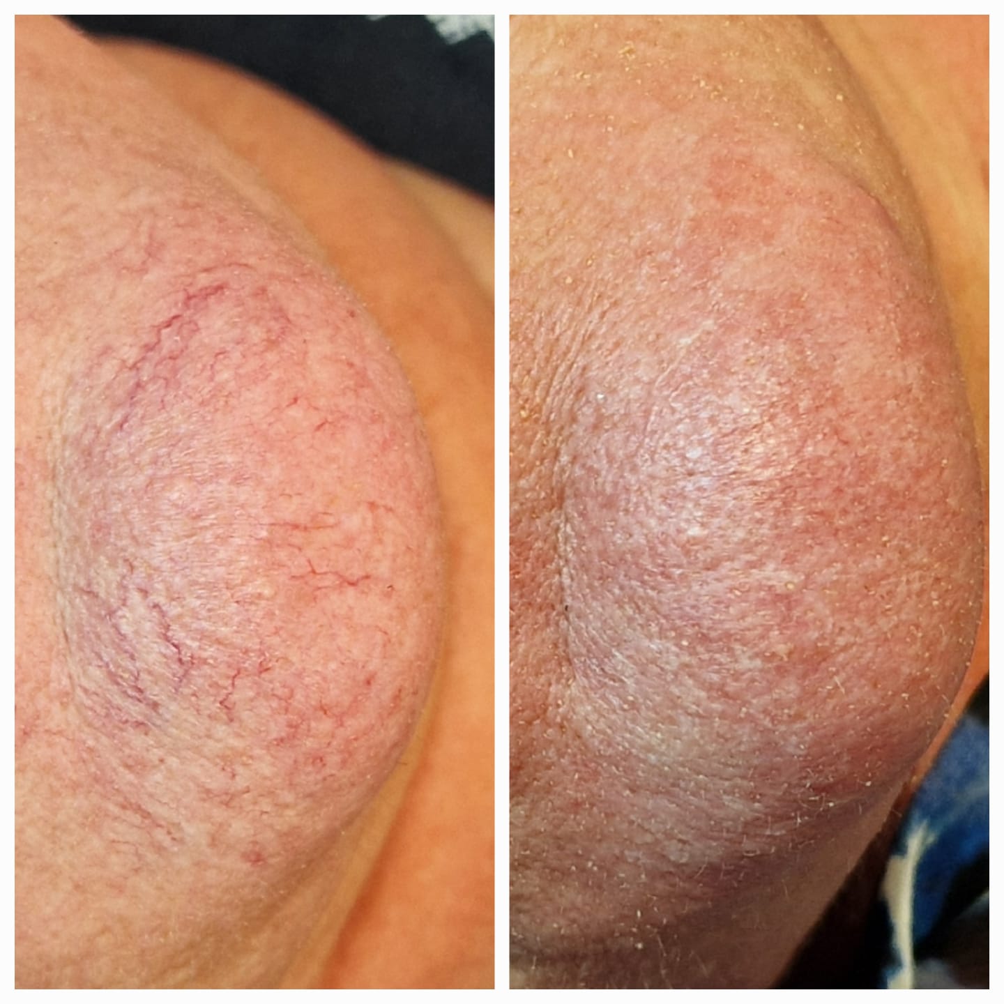 Före och efter laserbehandling av ytliga blodkärl, exempel 3