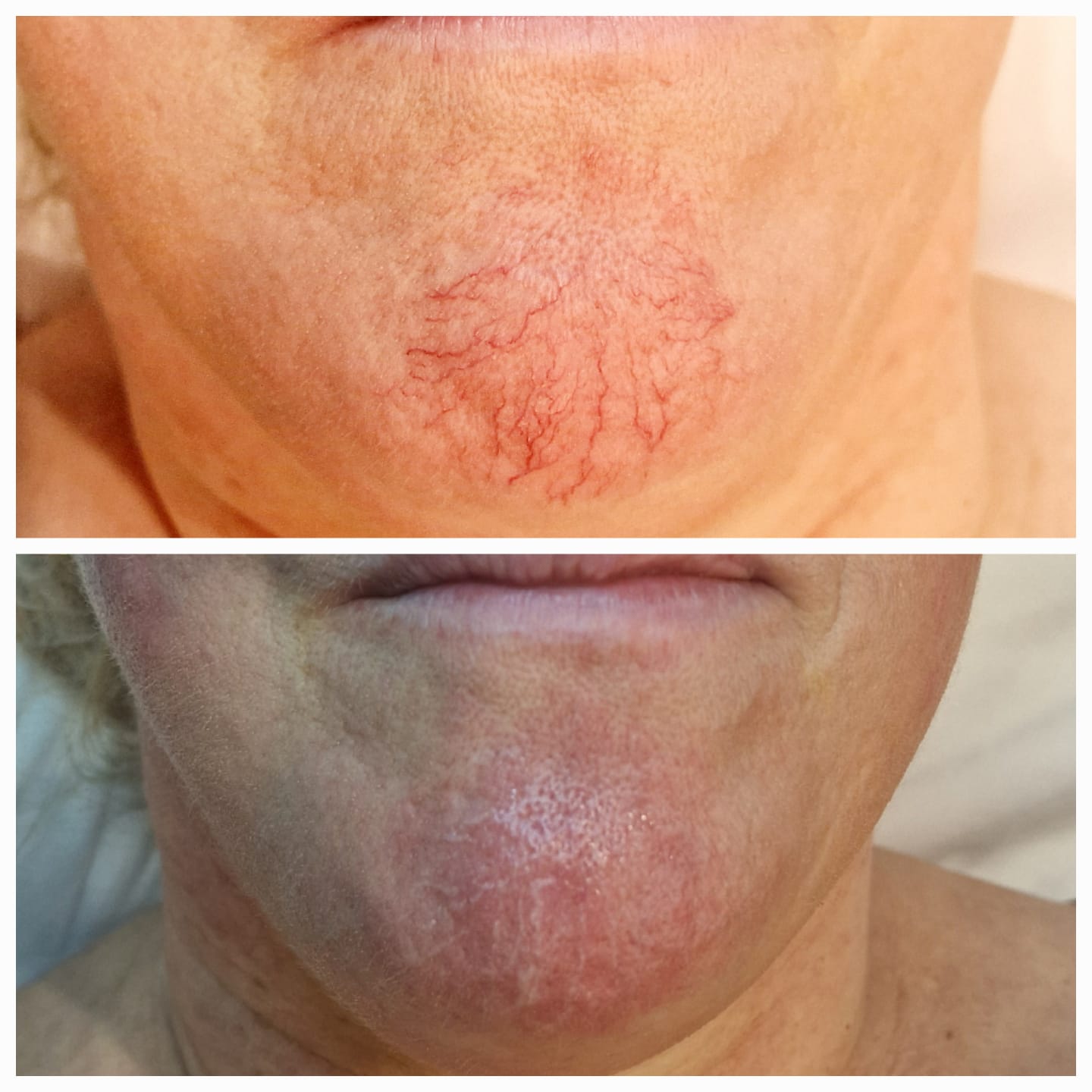 Före och efter laserbehandling av ytliga blodkärl, exempel 6
